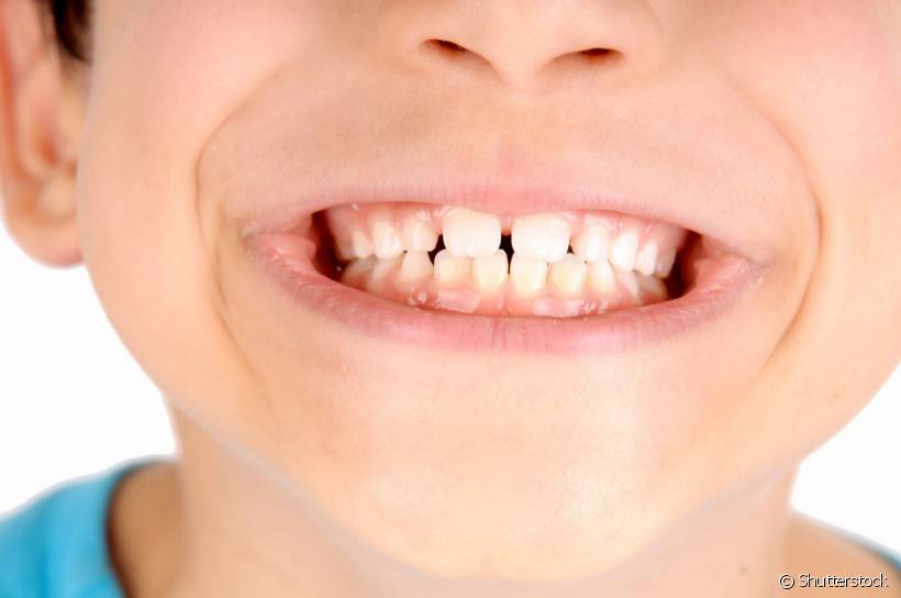 A fluorose dental são manchinhas nos dentes que podem variar de branca a marrom, a depender da sua intensidade, causadas pelo excesso de flúor durante a formação dos dentes