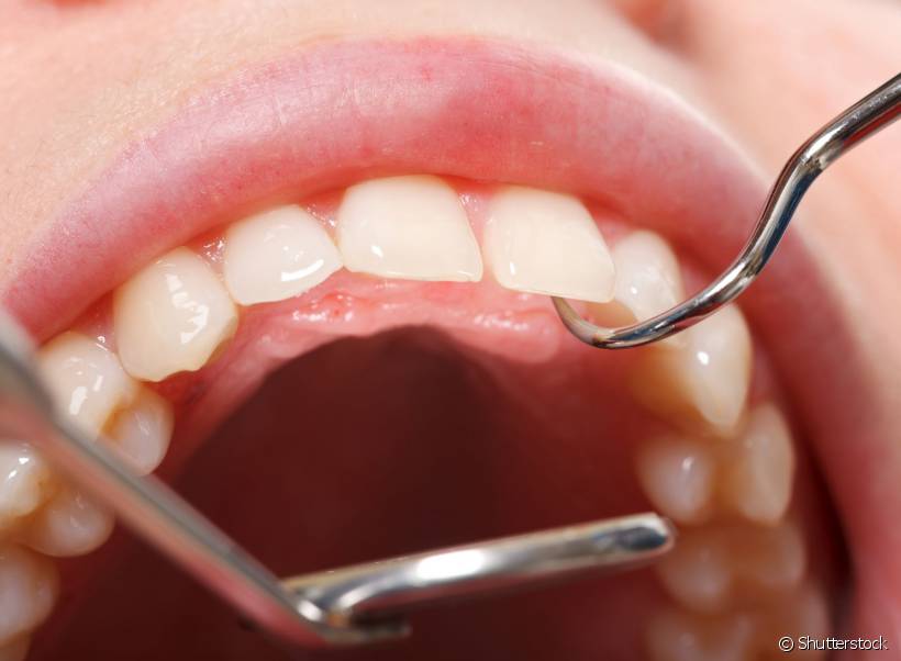 Dentes inclusos são aqueles que não nasceram por falta de espaço suficiente nas arcadas. Normalmente o problema atinge os dentes sisos, mas pode acontecer com todos os outros