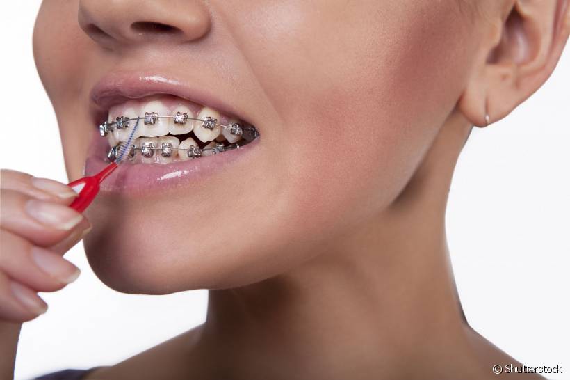 Aquele aspecto amarelado nos dentes que muita gente nota ao retirar o aparelho não é causado pelo acessório e, sim, pela má higiene bucal durante o tratamento ortodôntico