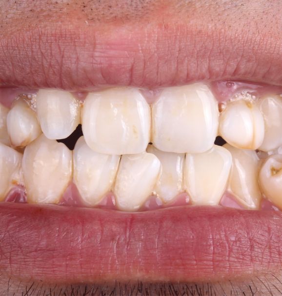 Nada melhor que corrigir aquele problema dentário que tanto te incomoda, né? Para isso, você pode contar com a ajuda da Ortodontia, especialidade que previne e corrige anormalidade no alinhamento dos dentes