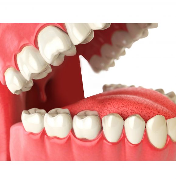 Perder um ou mais dentes muitas vezes atinge a saúde e o bem-estar da pessoa. Mas colocar implante dentário pode ser a solução para uma vida melhor. Confira as vantagens de aderir o procedimento e compare o resultado