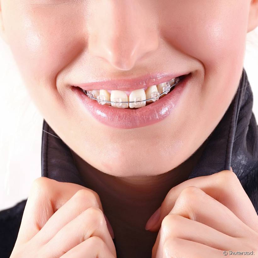 Nos primeiros dias a sensação de um aparelho dentário pode ser realmente estranha, mas logo você se habitua. É preciso mais cuidado ao comer e escovar os dentes a partir de agora